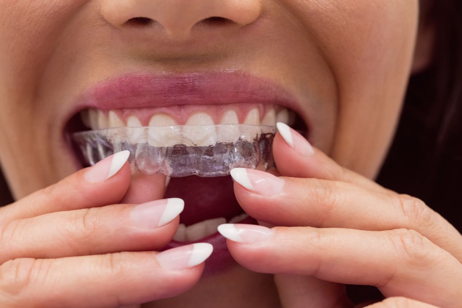 Invisalign – Clear Aligners